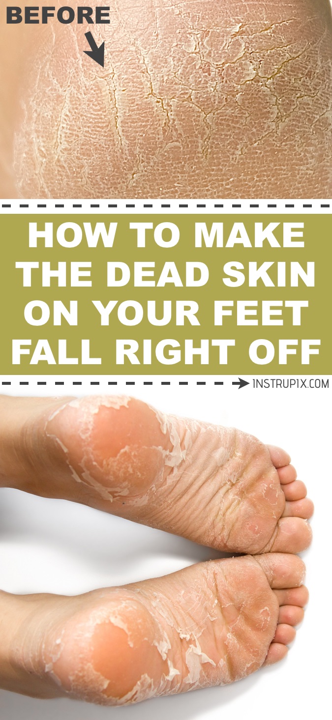 get the dead skin off your feet