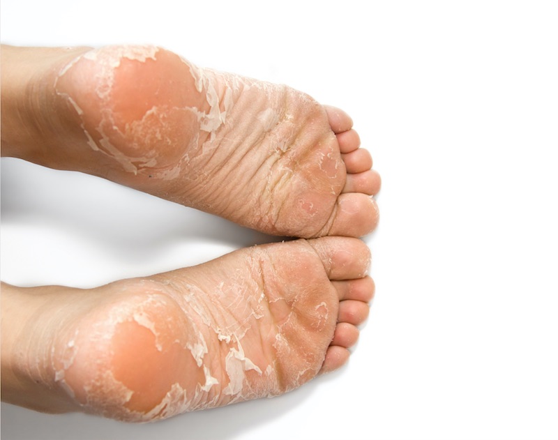 dead skin off feet listerine vinegar