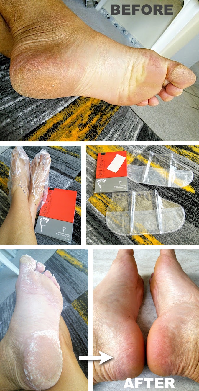 peeling dead skin off feet