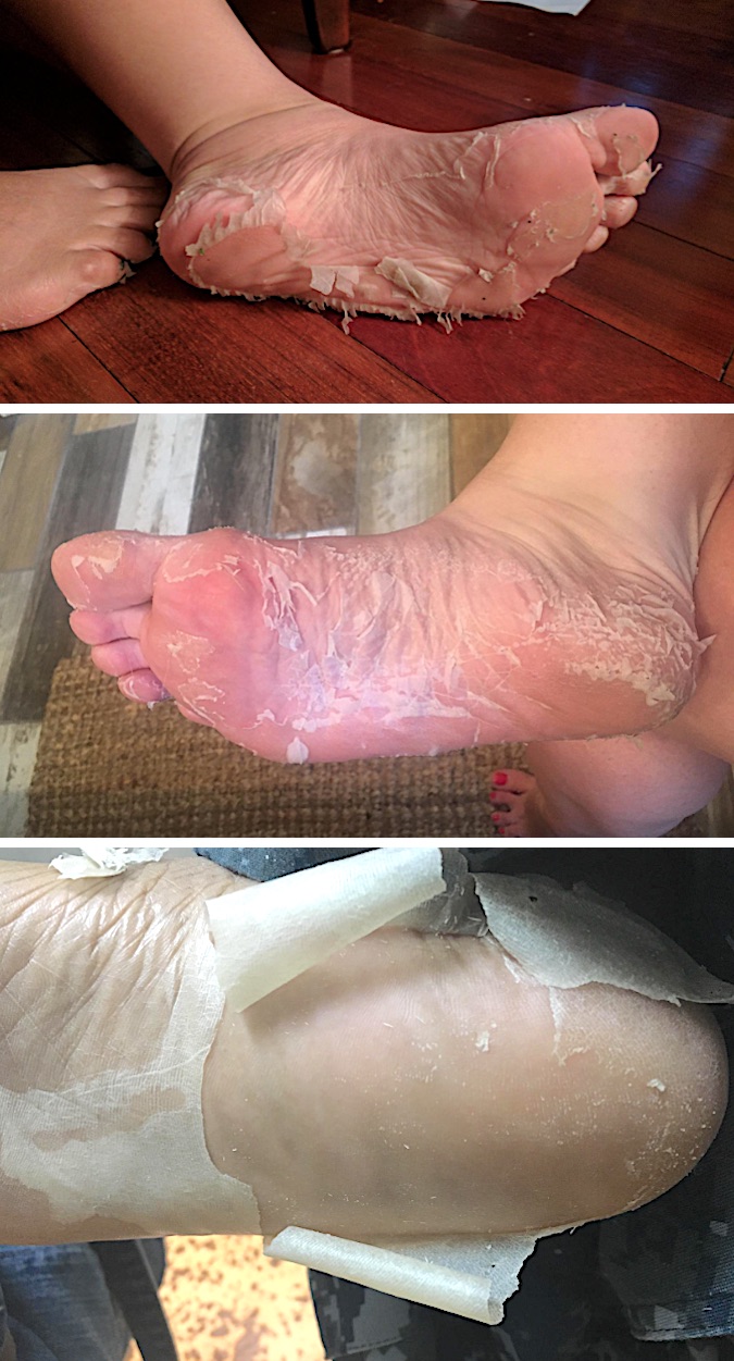 foot soak for hard skin