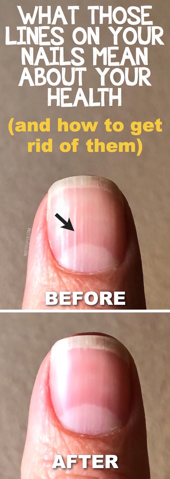 Are these vertical lines on my nails caused by my iron deficiency? Anyone  else have them? : r/Anemic